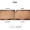 Microneedle Forehead Patch - 1 Face Mask