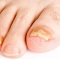 Medical - Antimycosis Nail Solution 7 Ml
