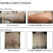 Bioactive Gel - Medical Device For Psoriasis 100 Ml