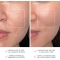 Luna 4 Plus - thermotherapy Device for normal skin