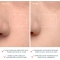 Luna 4 - thermotherapy Device for normal skin