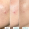 Centella Acne Care SOS Patch - anti-imperfection treatment 9 ml