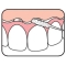 Bridge & Implant Floss - 30 dental floss for implants and bridges